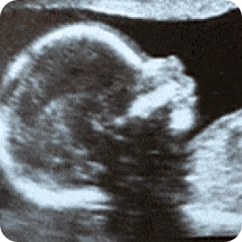 2d ultra sound