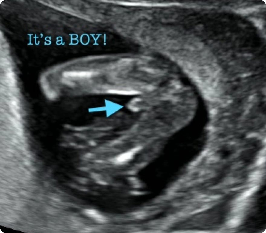 Gender Reveal 2D with HD Peek