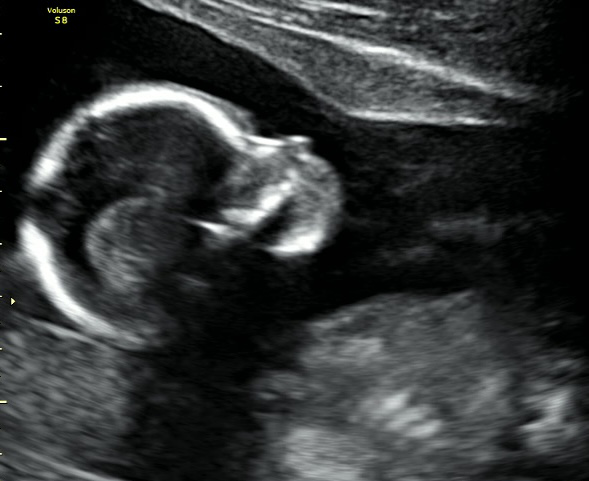 A baby’s ultrasound image showing face