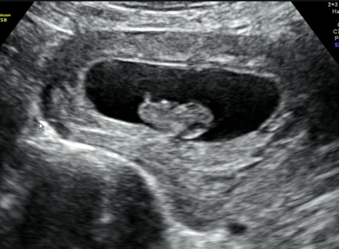 An ultrasound image of a baby