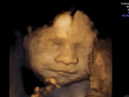3D ultrasound of a baby in the womb