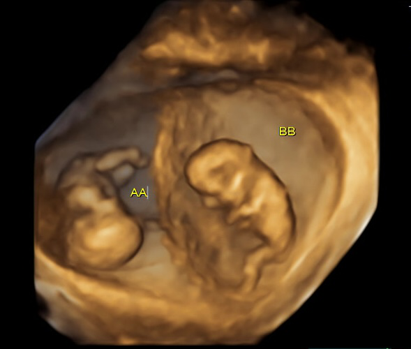 Ultrasound scan of twins in the womb