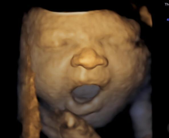 A baby yawning in an ultrasound