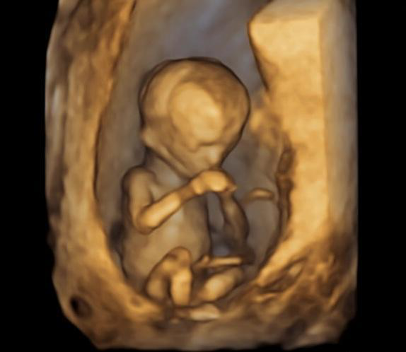A baby in an ultrasound