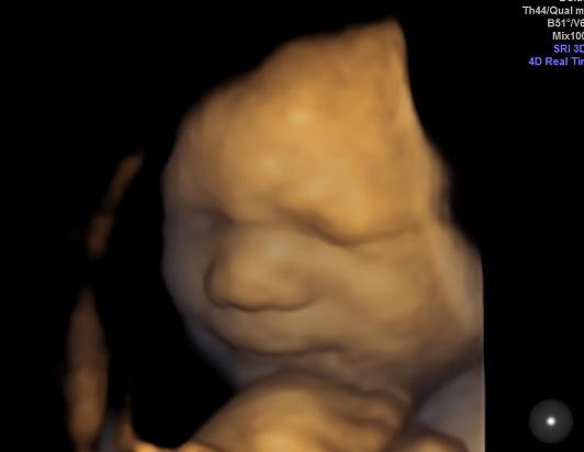 A baby in an ultrasound