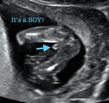 A 2D ultrasound scan showing the sex