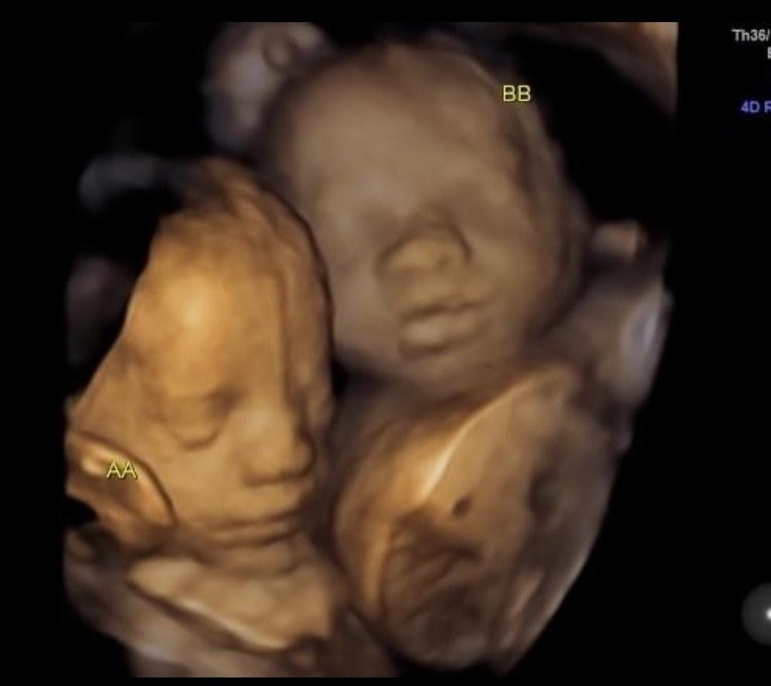 A twin ultrasound