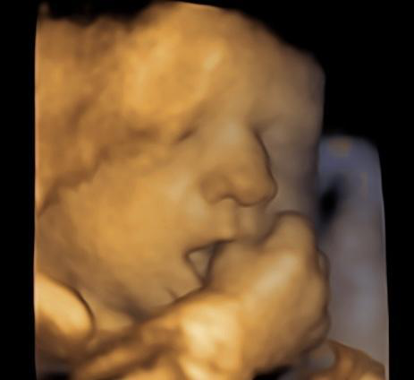 An ultrasound with a baby image