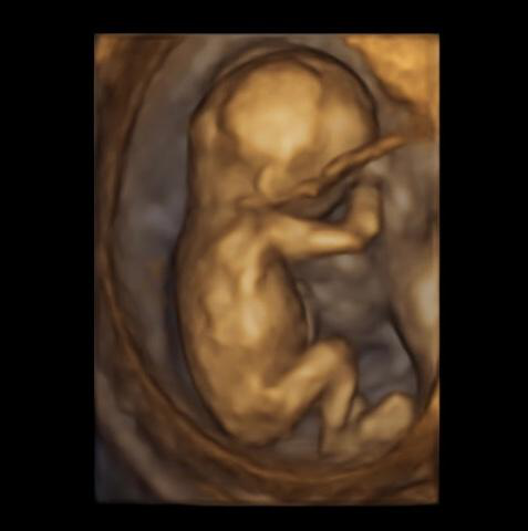 Ultrasound image of a fetus sucking their thumb